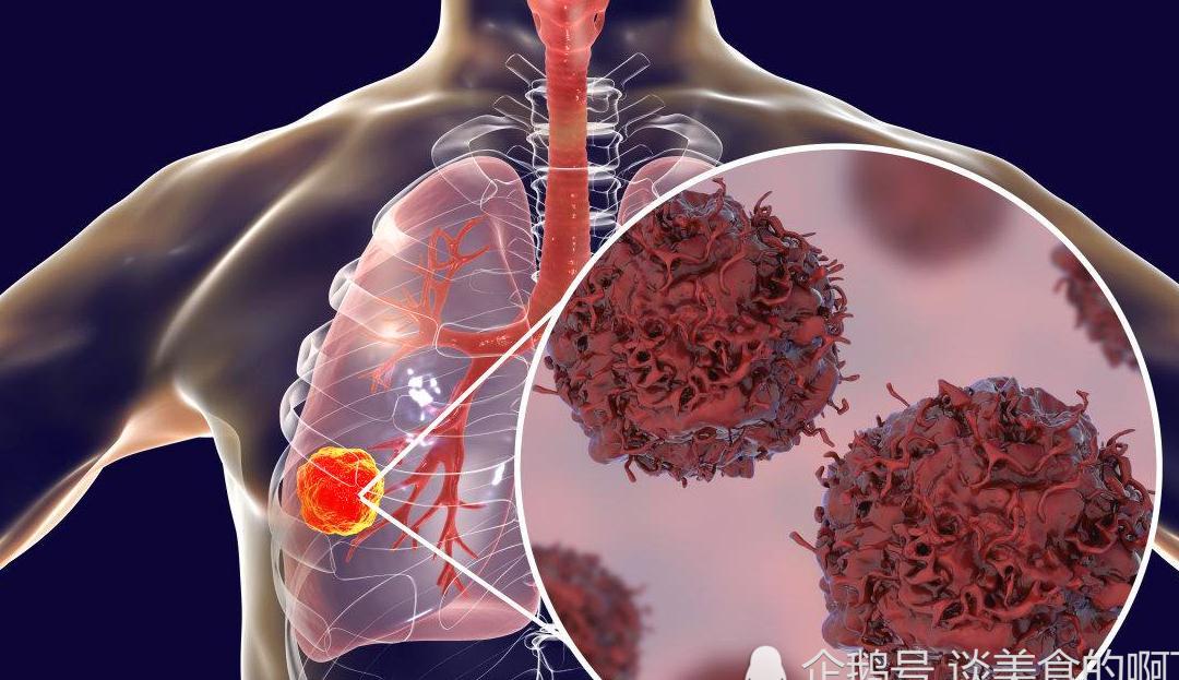 肺癌早期,身上可能有3处变肿4处发痛,若你没有,说明肺