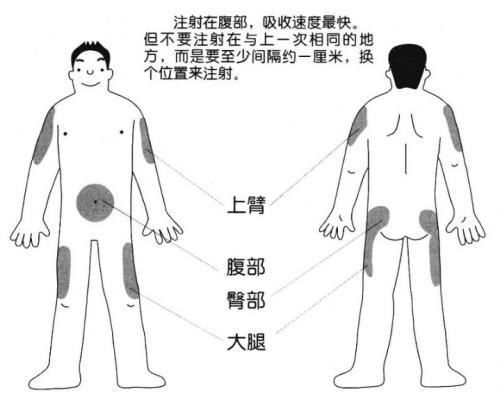 误区六,注射部位的选择