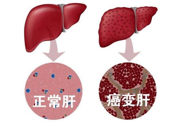 肝癌上身,男人1个地方变黑, 女人1个地方变大, 做到3点肝好20年