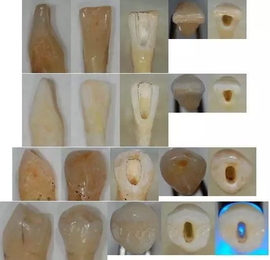 开髓过程中需要考虑到牙体长轴,而且边想象根管大概位置边靠近的话
