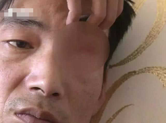 太原男子到爱尔眼科医院就诊被误诊摘除眼球!蒙在鼓里