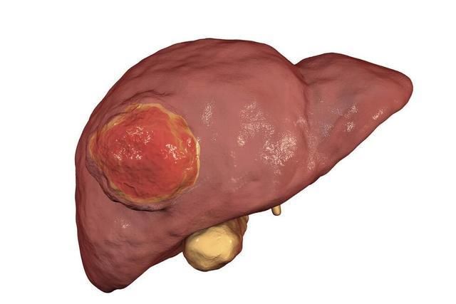 内科医生:肝癌不痛不痒,一旦脸上出现3种情况,是肝脏向你求救