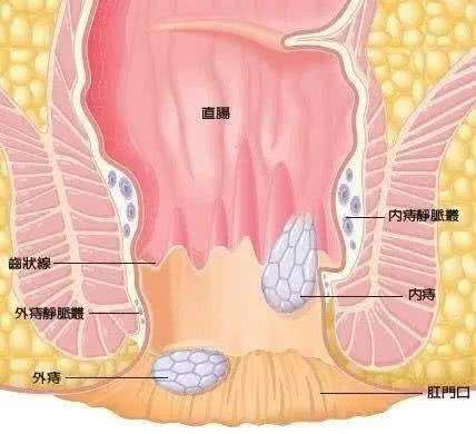 实际上,直肠癌早期症状与痔疮这两种病是有区别的 首先,便血不同.