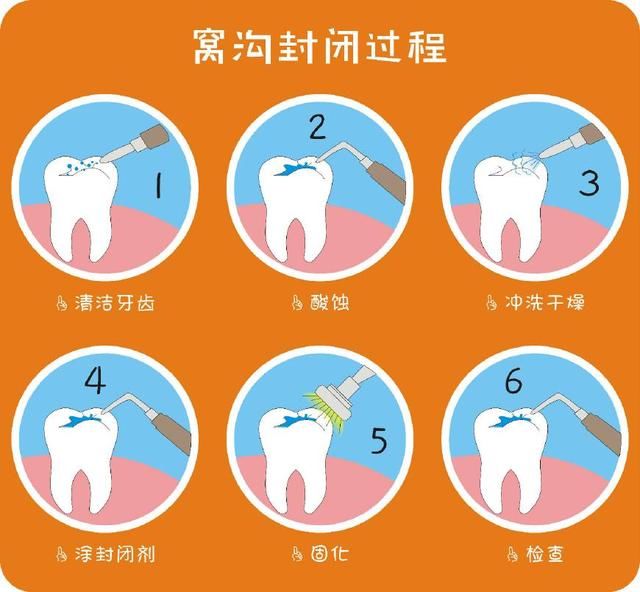 窝沟封闭你的宝宝做了吗?作为父母的您又了解多少呢?