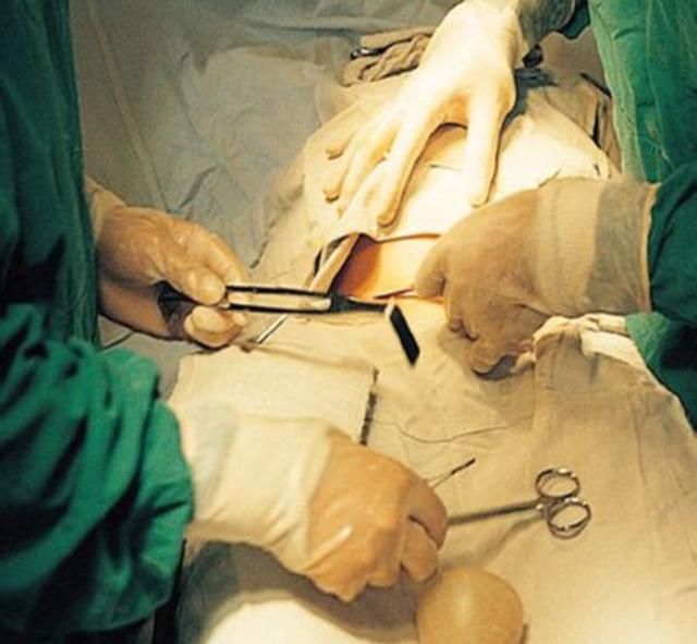 图解女人剖腹产手术全过程,胆小者勿入!