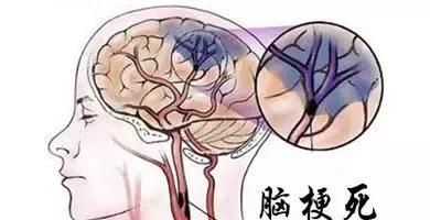 脑梗塞,脑血栓,脑出血的区别,值得收藏!