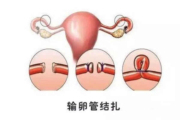 输卵管复通_输卵管复通手术