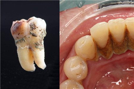 【图】自己怎么去除牙石 教你清洗小妙招