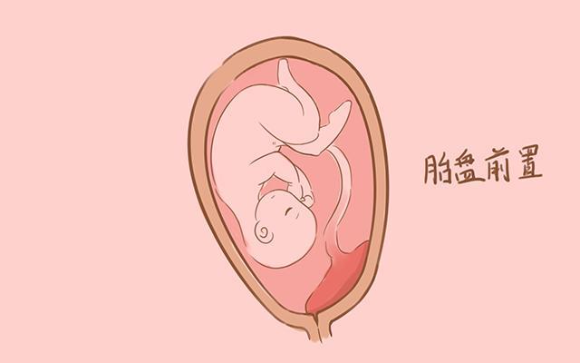 孕早期检查的时候,发现宝宝胎盘前置的状态,会容易出血流产吗?