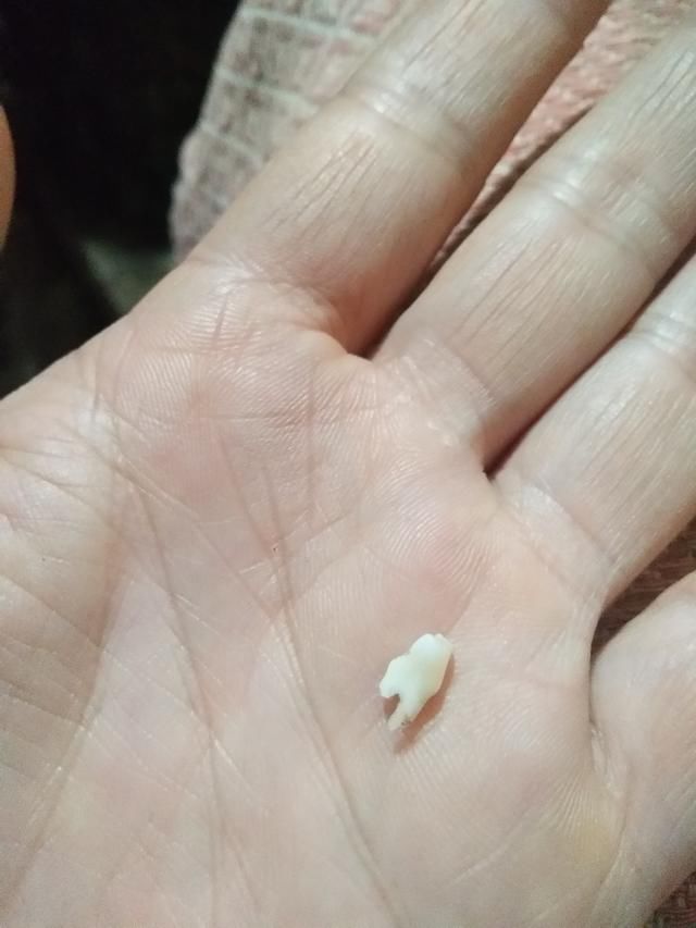 孩子换牙,没掉牙先长牙.