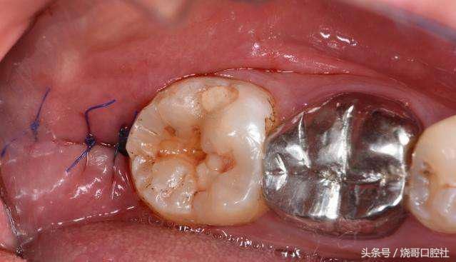 拔牙后不拆线可以吗?