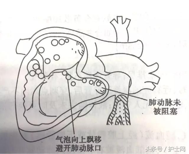 中心静脉导管拔除后,穿刺点如何处理?
