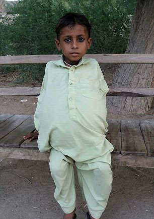 巴基斯坦男孩患罕见结肠症 腹部浮肿如球