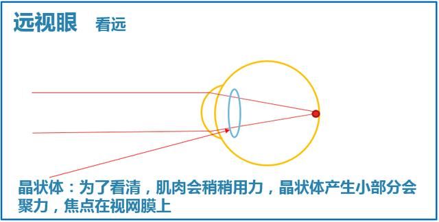 科普|近视、远视、散光、老花
