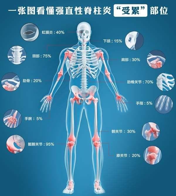 买保险一年后患强直性脊柱炎强直性脊柱炎能保险吗