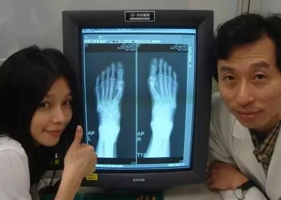 女星的脚真恐怖:徐若瑄要做手术,王子文命最