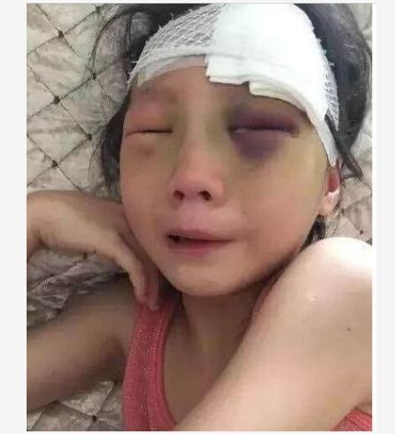 妈妈在医院里生二胎,却没想到大宝在家被打得鼻青脸肿 妈妈在医院里生二胎,却没想到大宝在家被打得鼻青脸肿