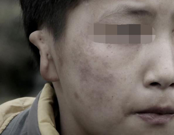 重庆国信奥丽整形接过西南医院公益接力棒