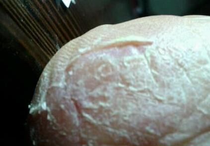 冬天脚底长老茧开裂了怎么回事?脚底长老茧开