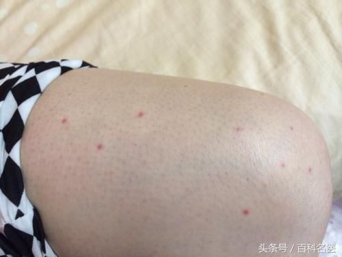 身上长了许多小红点,可能是脂肪肝、肝炎、肝