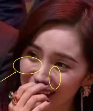 张檬取出假体后,脸上笑沟胜过杨幂?网友:总算