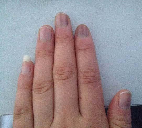 患上黑色素瘤,指甲上会出现这个信号,看到了别