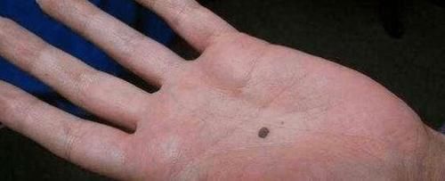 女子在手上画黑痣自拍,朋友看到后立即报警,网友都说学到了!