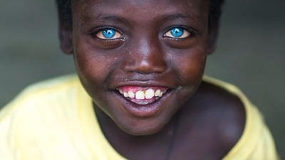 男孩天生蓝眼睛似混血儿 没想到竟是得了罕见病