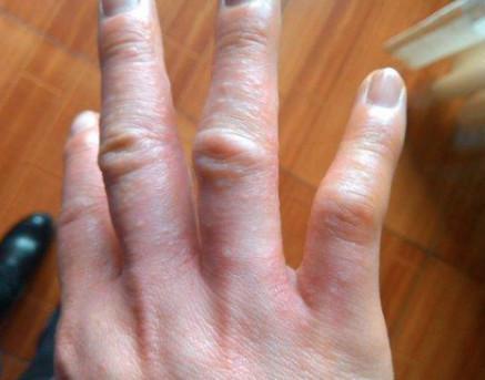 手背上起小水泡,透明的,这是什么病?针对病因治疗