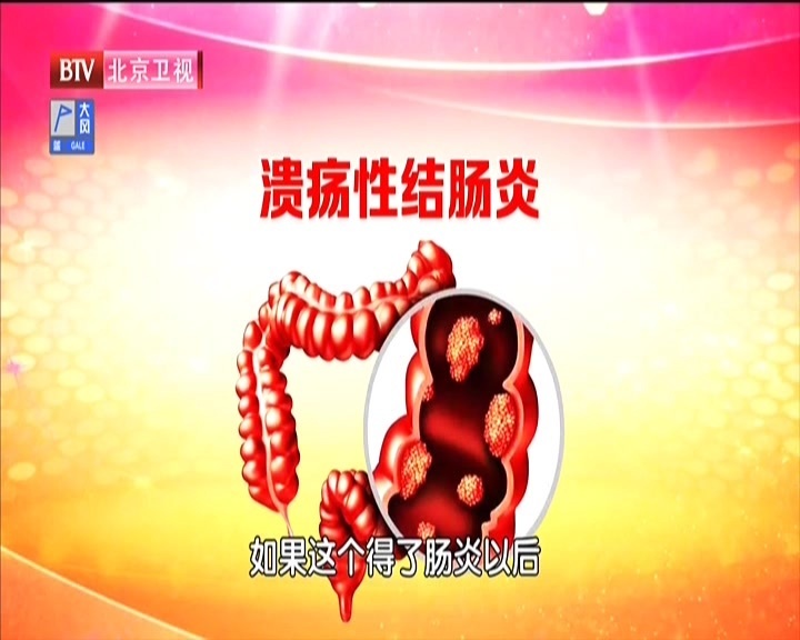溃疡性肠炎的诱发因素