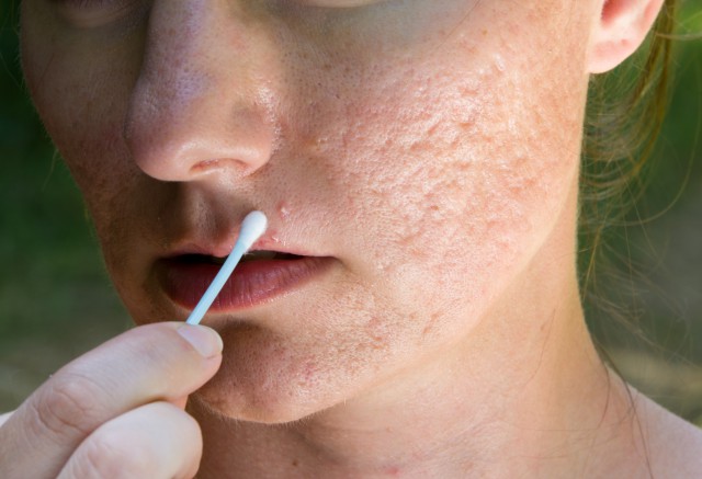 炎症痘痘怎么才能好 教你有效治疗的几点方法