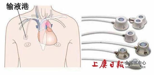 上虞中医医院成功完成首例静脉输液港植入术