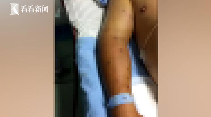 男子全身被马蜂蜇200多处险丧命 被蜂蜇了别轻视 男子全身被马蜂蜇200多处险丧命 被蜂蜇了别轻视