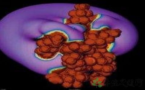 糖尿病血糖低的症状