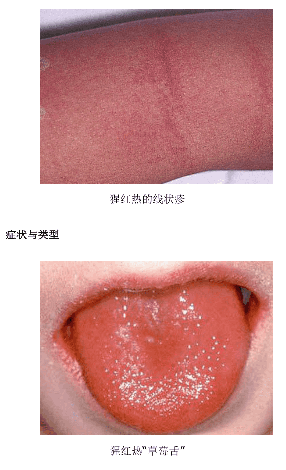 猩红热高发!出现这些症状要当心——_北京时间