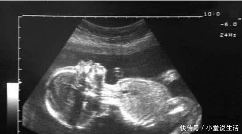 预产期快到,胎儿却胎死腹中,医生检查后,骂孕妇