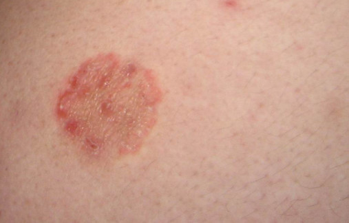 铜钱癣传染,科学治疗才是王道