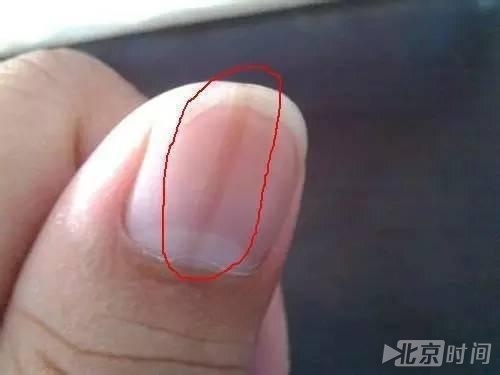 指甲有竖纹 是身体在向你发出警告