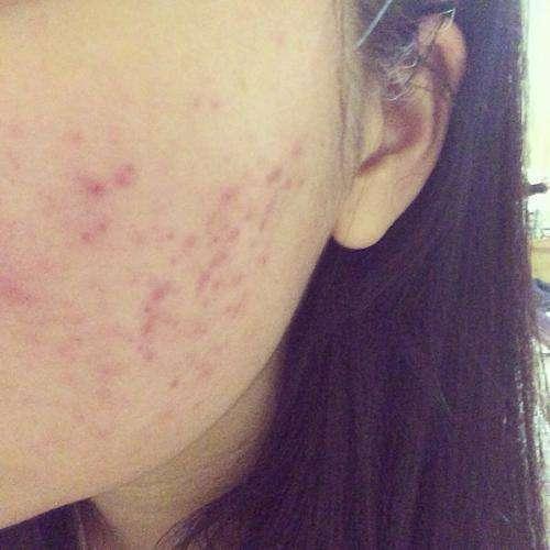 去痘印痘坑的小妙招,简单实用,省了去医院的钱