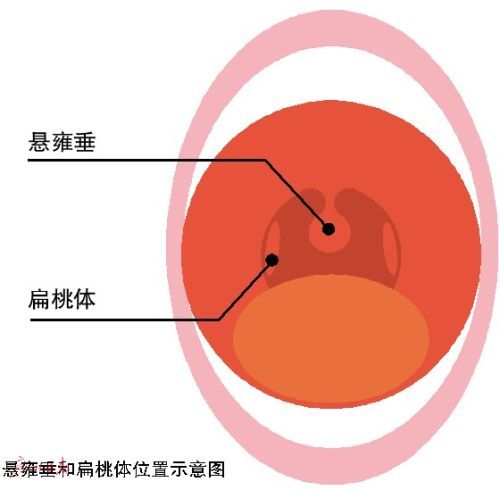 新生儿悬雍垂图片图片