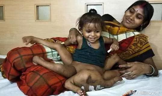 为什么印度会出现很多畸形儿:原因出现在这里