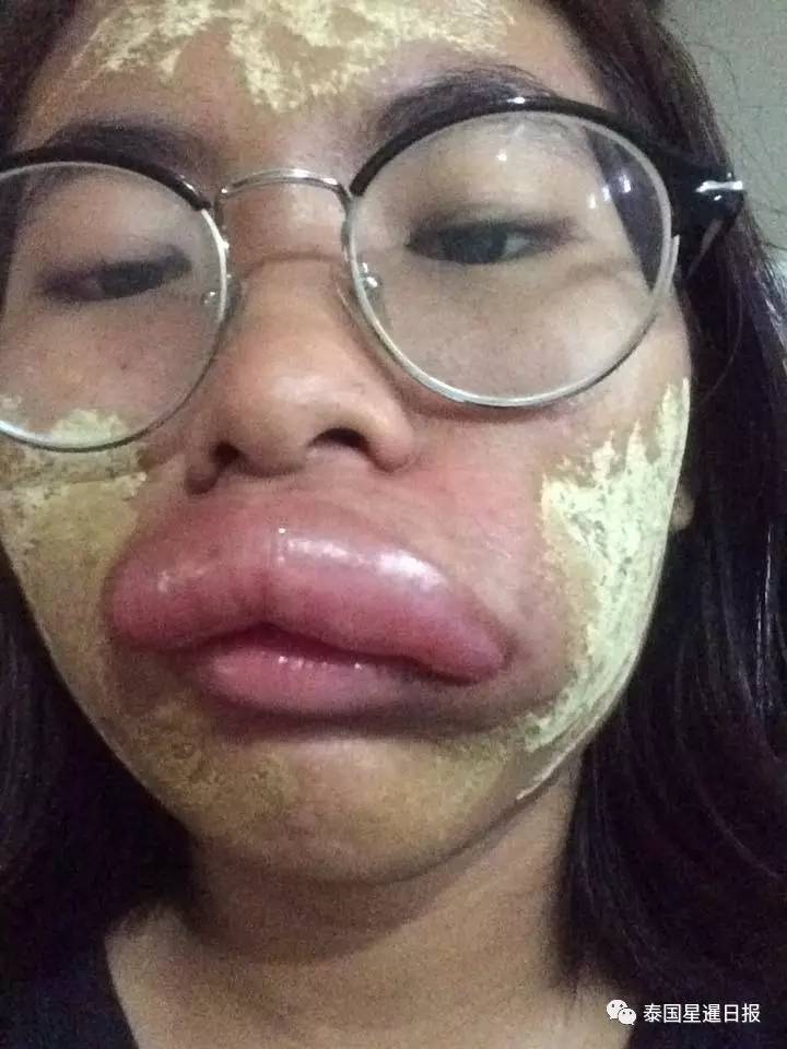 她近期在汽车时没有戴好防护帽子,结果迎风吹来一不明虫子,将她嘴巴撞