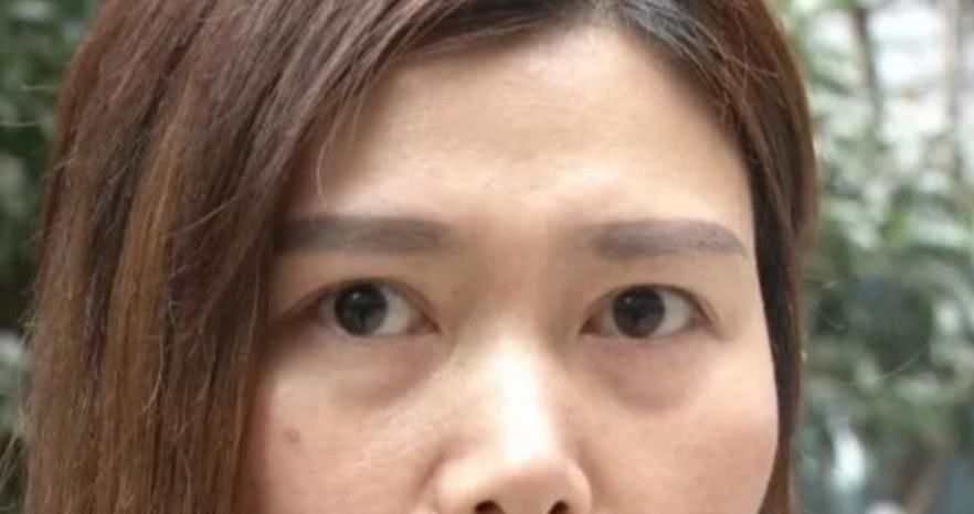 女子花一万八割欧式双眼皮,割完后眼皮下垂,医