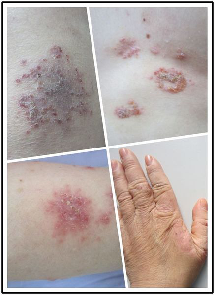 3,感染因素:像是在生活之中患上湿疹的话,其实和微生物的感染关系密切
