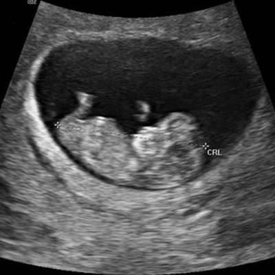 孕期第10周胎儿发育全过程,胎宝宝像金橘那么