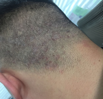 长头癣怎么办,去除头藓不留痕迹