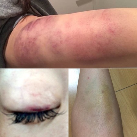写真女星曝遭前老板痛殴 监禁半年浑身骨折淤青