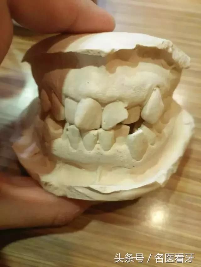 牙齿矫正|拥挤不齐,门牙缺失!人家说戴牙套瘦多