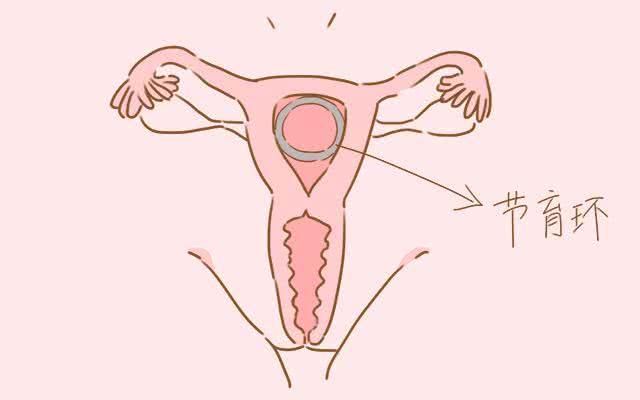 节育环:这种方法就是在女性的子宫中放置避孕装置.