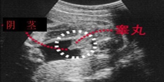 四维彩超看胎儿性别 B超怎么看男女